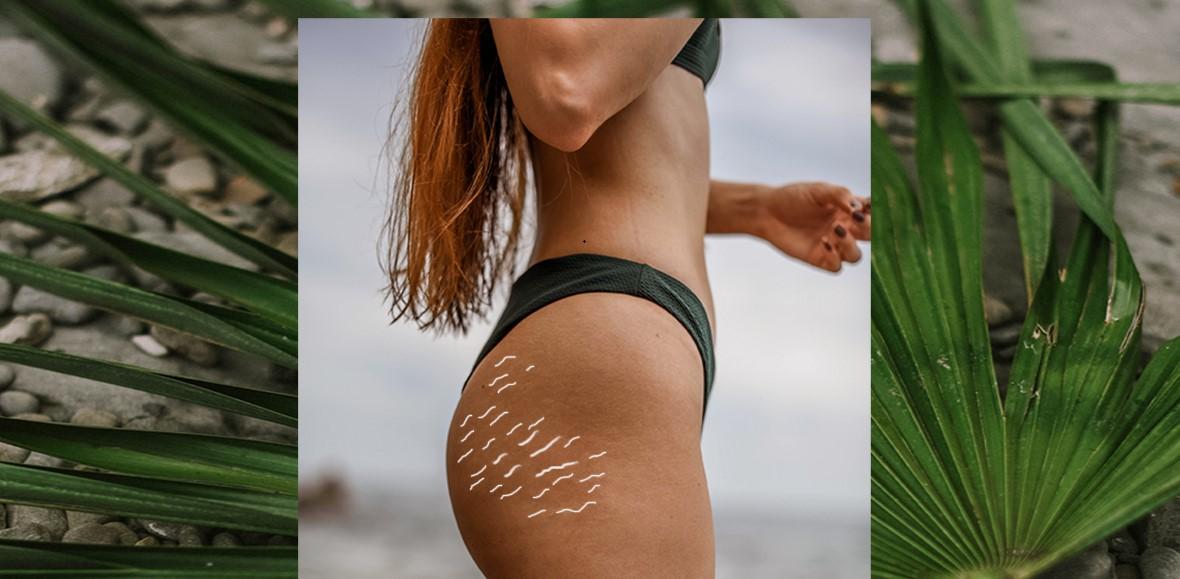 Gå igennem Sightseeing På daglig basis Does Fake Tan Cover Stretch Marks? (Self & Spray Tanners)