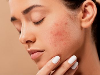 Does Exfoliating Help with Acne featured