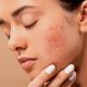 Does Exfoliating Help with Acne featured