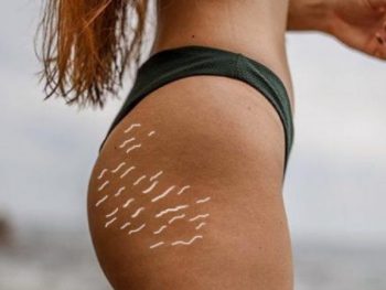 How Does Exfoliation Help with Stretch Marks featured